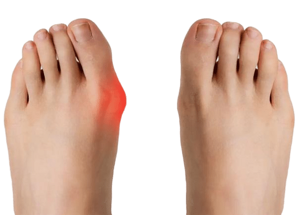 اسپلینت هالوکس والگوس FeetiFix